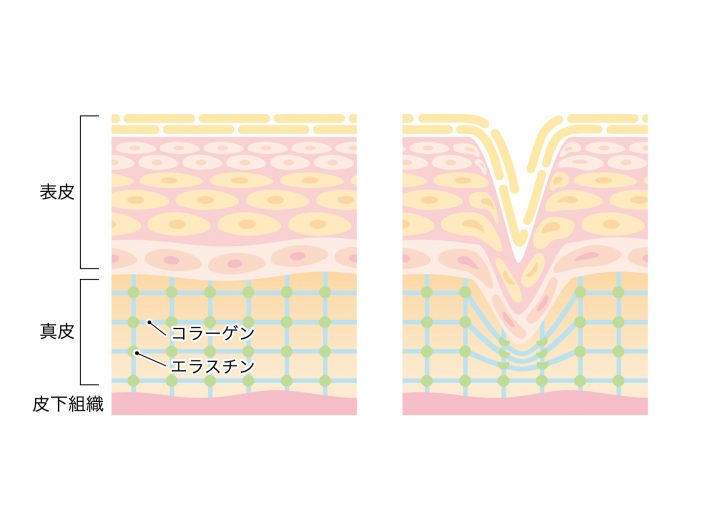 ほうれい線が朝になるとできる原因と対策法 | ゆりちゃんねるのブログ